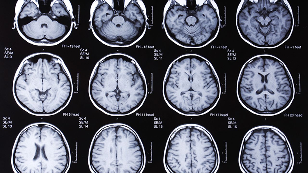 Prion hastalığı nedir, nasıl bulaşır? Türkiye'de var mı?