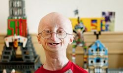 Progeria (Yaşlanma Hastalığı) nedir? Belirtileri nelerdir? Kimlerde görülür? Progeria hastalığı yaygın mıdır?