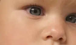 Çocuklarda sık görülen 'yalancı şaşılık' nedir?