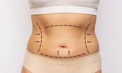 Sosyal medyanın etkisiyle artan liposuctionda nelere dikkat edilmeli?