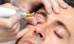 Plazma Pen Uygulaması nedir, neden yapılır?