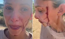 Can Yaman'ın sevgilisi Sara Bluma şiddet gördüğü görüntüleri paylaştı