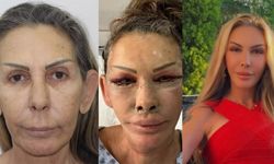 Petek Dinçöz'ün annesi yüz gençleştirme ameliyatı olmuştu! Son halini doktoru paylaştı