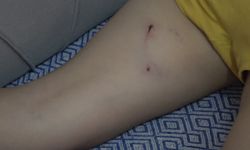 5 yaşındaki çocuk, sokak köpeğinin saldırısına uğradı