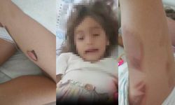İzmir'de akılalmaz iddia: 3 yaşındaki Yaren, ameliyattan yanık izleriyle çıktı