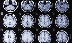 Prion hastalığı nedir, nasıl bulaşır? Türkiye'de var mı?