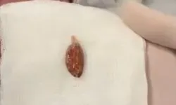 Yuttuğu cevizle ölümden döndü! Doktorlar zamanla yarıştı