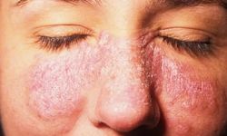 Kelebek hastalığı kadınlarda 9 kat fazla görülüyor