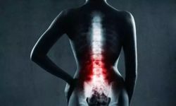 Omurga romatizması gençleri hedef alıyor