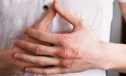 Kış aylarında egzama vakaları artışta: Sıcak su ve yanlış nemlendiriciye dikkat