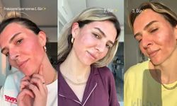 Survivor Merve Aydın'ın yüzüne yaptırdığı işlem sosyal medyada gündem oldu