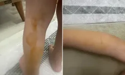 Sokak köpeği 3 yaşındaki çocuğa saldırdı