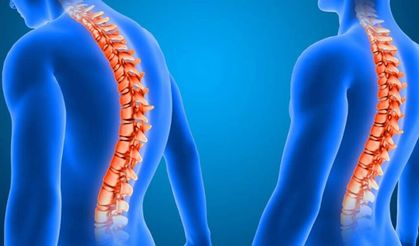 Skolyozda erken tanı uyarısı: Ergenlikte hızla ilerliyor