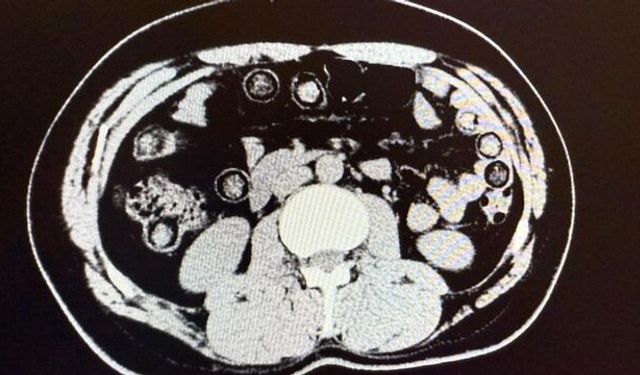 Midelerinden çıkanlar şok etti: Gerçek tomografi sonucunda ortaya çıktı!