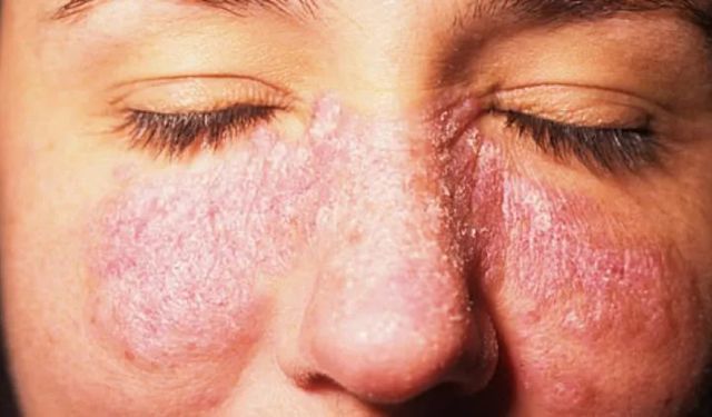 Kelebek hastalığı kadınlarda 9 kat fazla görülüyor