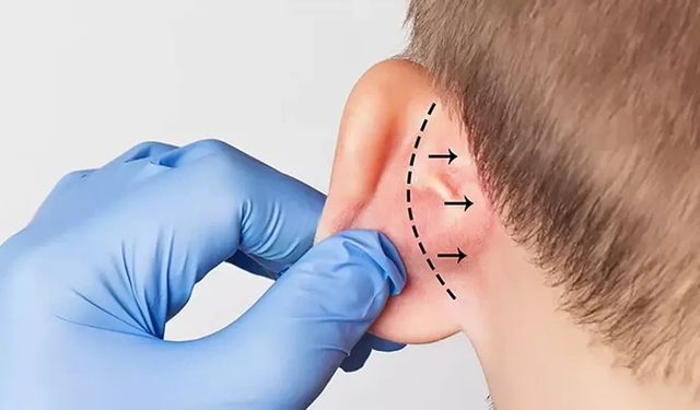 Kepçe kulak sorunu, çocukların psikolojisini olumsuz etkiliyor