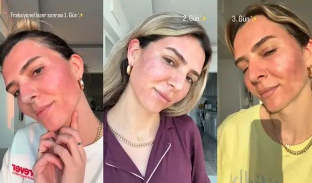 Survivor Merve Aydın'ın yüzüne yaptırdığı işlem sosyal medyada gündem oldu