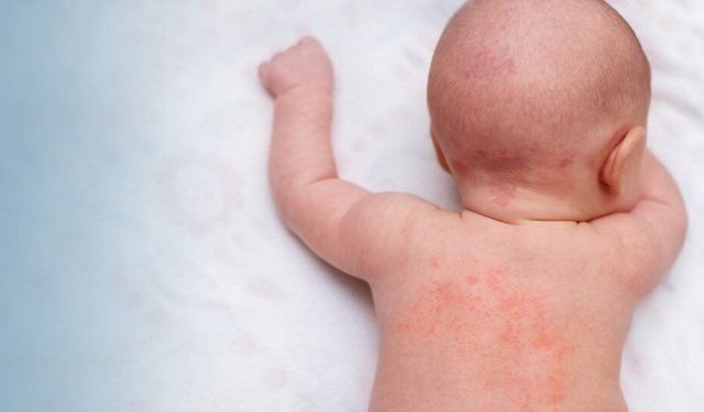 Bebeklerde sık görülen isilik, doğru bakımla önlenebilir