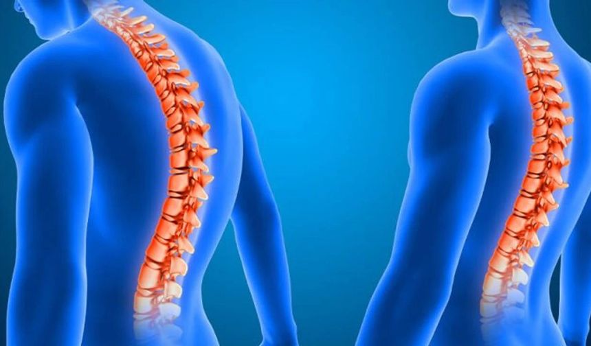Skolyozda erken tanı uyarısı: Ergenlikte hızla ilerliyor