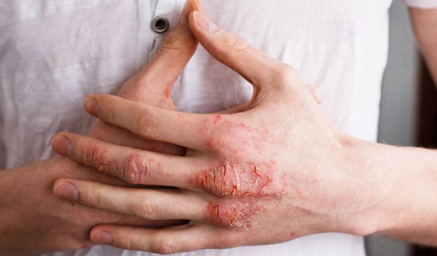 Kış aylarında egzama vakaları artışta: Sıcak su ve yanlış nemlendiriciye dikkat